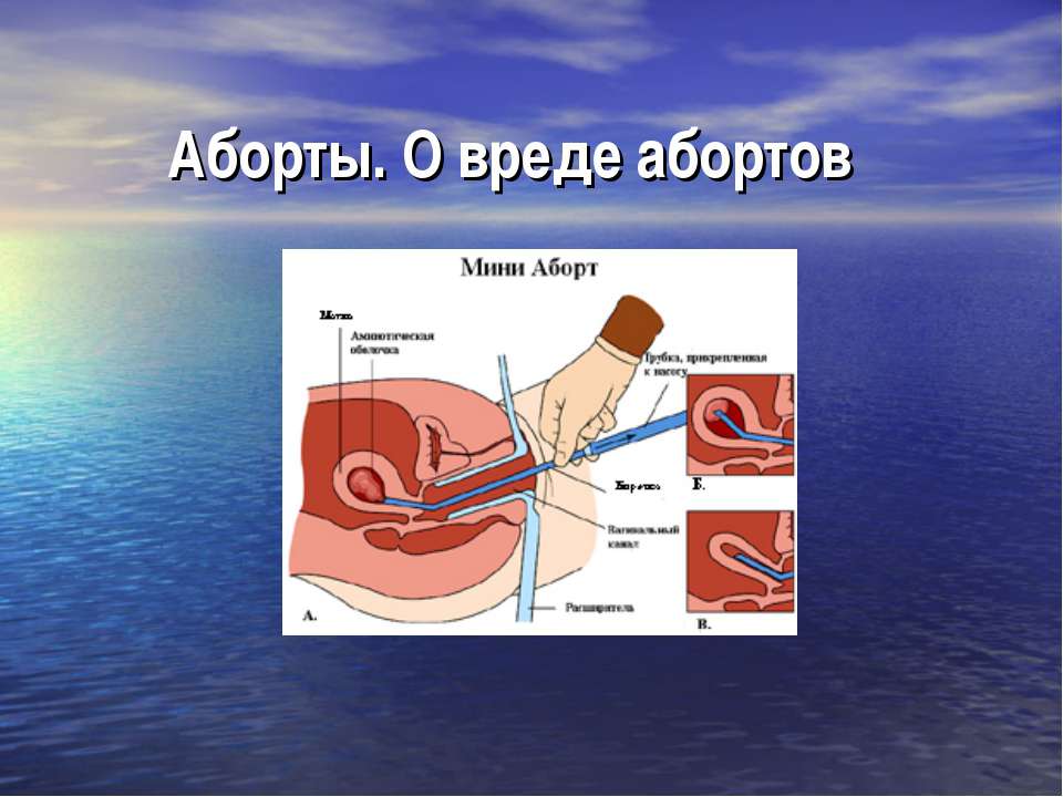 Аборты. О вреде абортов Учебники, Презентации и Подготовка к Экзаменам для Школьников на Klass-Uchebnik.com
