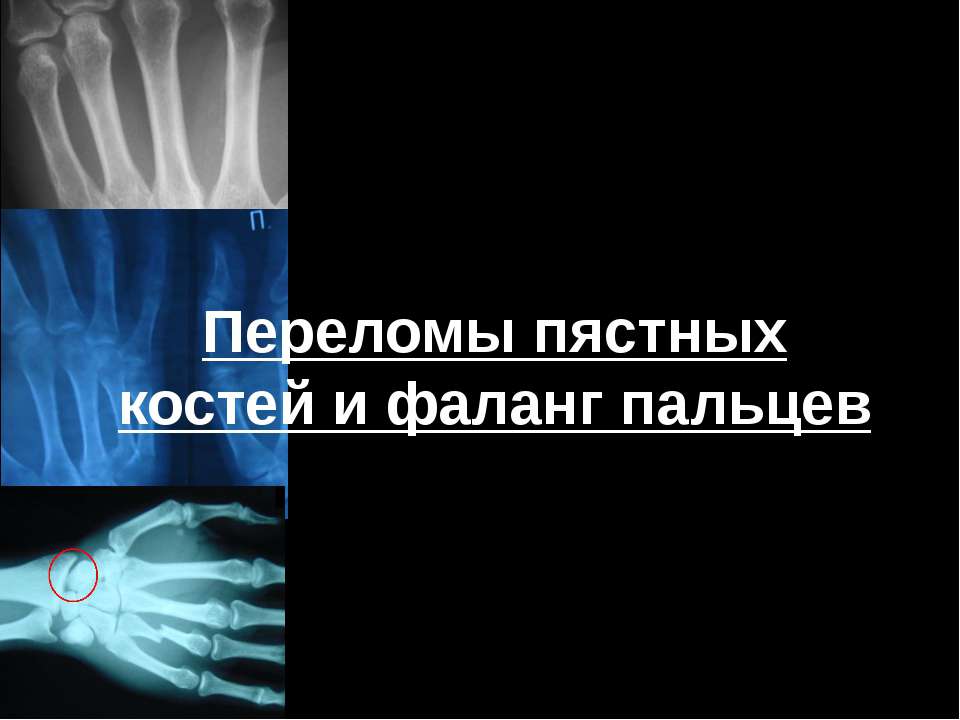 Переломы пястных костей и фаланг пальцев - Учебники, Презентации и Подготовка к Экзаменам для Школьников на Klass-Uchebnik.com
