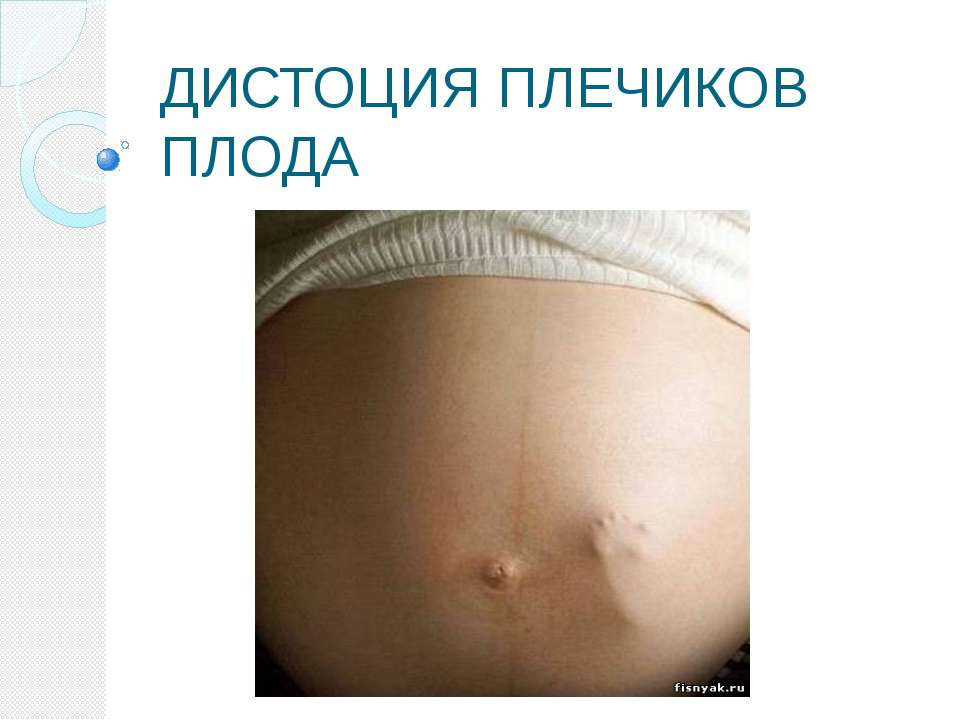 Дистоция плечиков плода Учебники, Презентации и Подготовка к Экзаменам для Школьников на Klass-Uchebnik.com