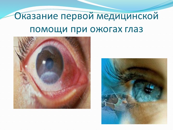 Презентация на тему: "Оказание первой медицинской помощи при ожогах глаз" Учебники, Презентации и Подготовка к Экзаменам для Школьников на Klass-Uchebnik.com