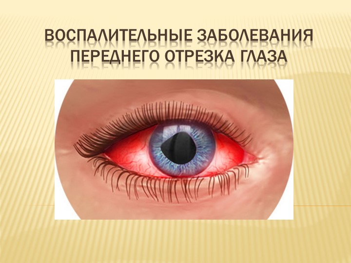 Презентация на тему "Воспалительные заболевания переднего отрезка глаза" Учебники, Презентации и Подготовка к Экзаменам для Школьников на Klass-Uchebnik.com